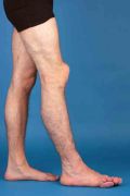 Patient mit Proteus Syndrom und venöser Malformation des Beins